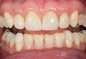 Dental Excellence | Sedation Dentistry, Dental Bridges and Veneers