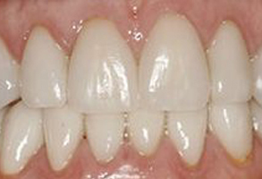 Dental Excellence | Dentures, Veneers and Teeth Whitening