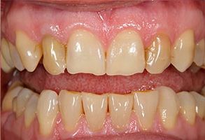 Dental Excellence | Dentures, Dental Bridges and Dental Fillings
