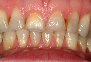 Dental Excellence | Extractions, Dental Bridges and Implant Dentistry
