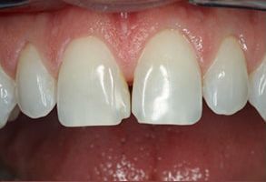 Dental Excellence | Veneers, Implant Dentistry and Crowns  amp  Caps